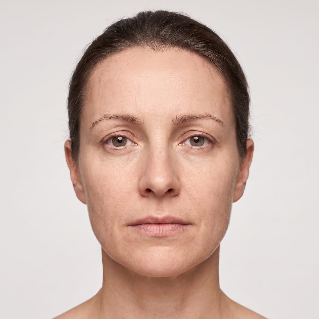 Forehead after anti-wrinkle treatment
